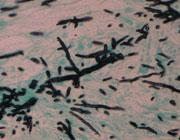 UAMH 11627 tissue specimen 21093430 showing hyphae of Neosartorya laciniosa stained with GMS